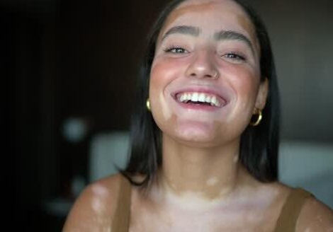 Opzelura, le premier médicament contre le vitiligo, disponible en pharmacie le 27 juillet 2024