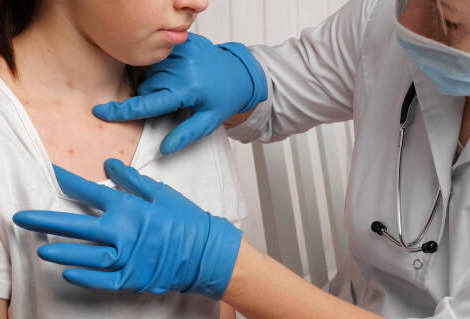 Monkeypox info service : un numéro pour orienter les patients