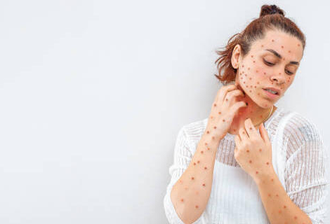 Mpox : l&rsquo;OMS alerte sur le risque de cas importés en Europe