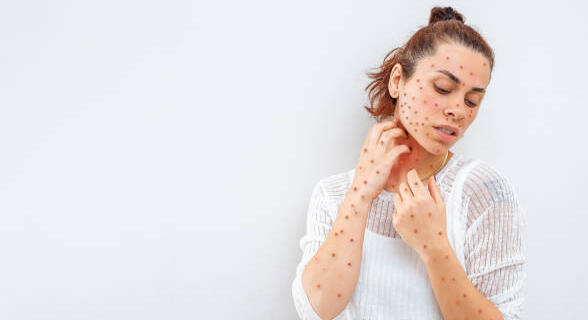 Mpox : l&rsquo;OMS alerte sur le risque de cas importés en Europe