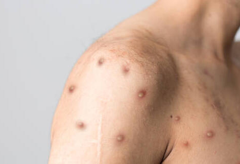 Variole du singe : +160 % de cas depuis 2022, l&rsquo;OMS réunit un comité d&rsquo;urgence