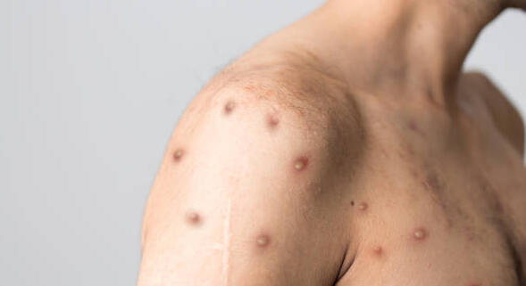 Variole du singe : +160 % de cas depuis 2022, l&rsquo;OMS réunit un comité d&rsquo;urgence