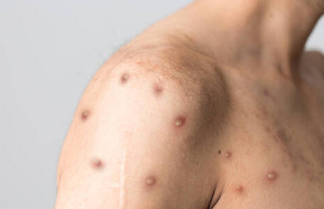 La variole du singe pourrait être qualifiée d&rsquo;urgence de santé publique par l&rsquo;OMS