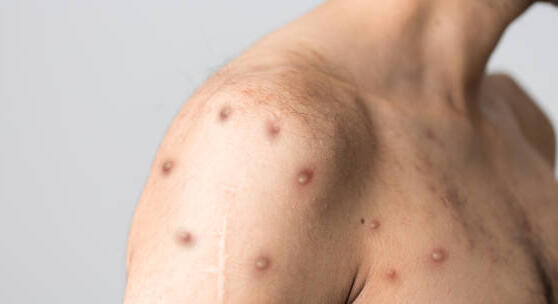 La variole du singe pourrait être qualifiée d&rsquo;urgence de santé publique par l&rsquo;OMS