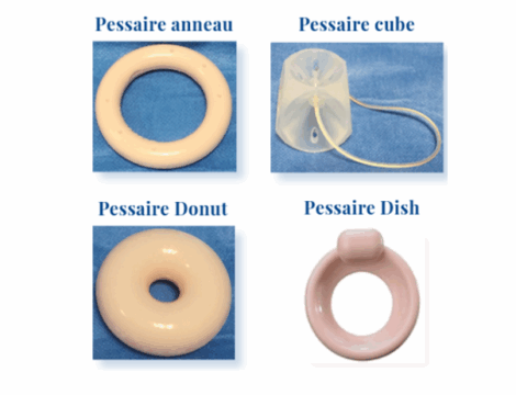 Pessaires : inscription au remboursement