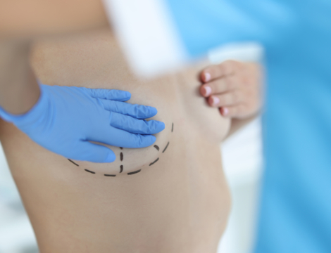 La prévision d’une radiothérapie adjuvante pour un cancer du sein empêche-t-elle la reconstruction mammaire lors de la mastectomie ?