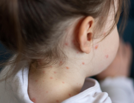 Explosion des cas de rougeole dans le monde : un échec de la couverture vaccinale
