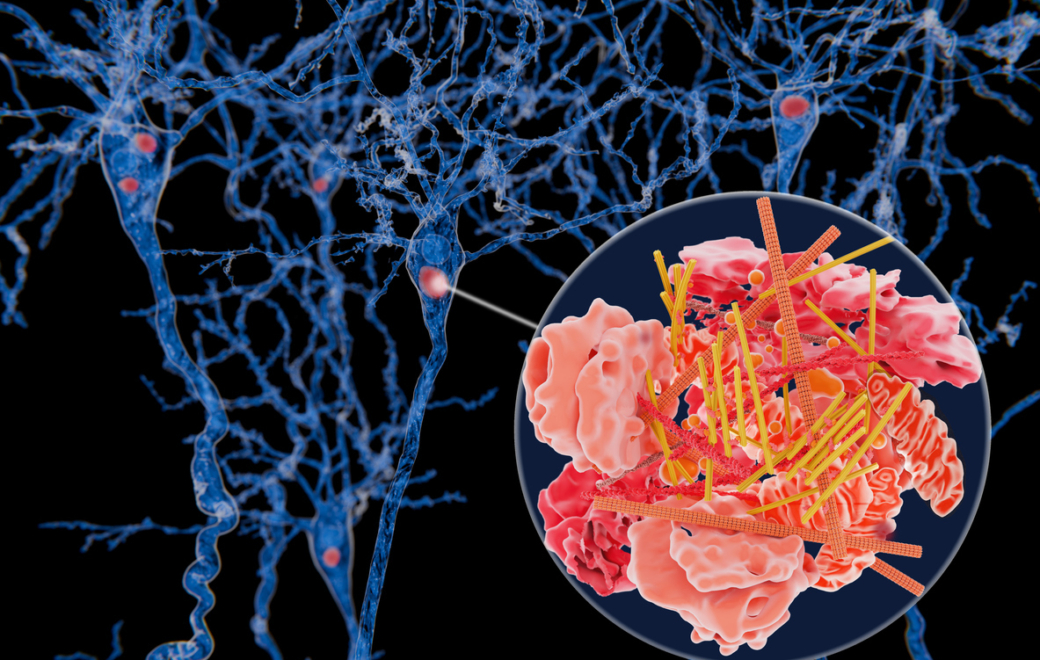 Qu’est-ce que la démence à corps de Lewy ?