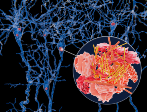 Qu’est-ce que la démence à corps de Lewy ?