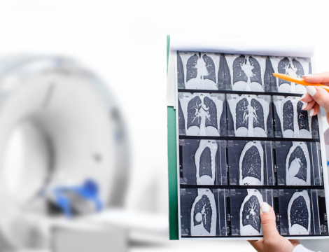 Dépistage du cancer du poumon : une expérimentation sous forme de programme pilote