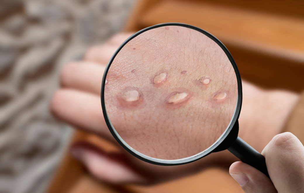 Mpox : premier cas de clade I en France