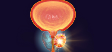 Pharmaciens et cancer de la prostate : les clés pour une prise en charge  optimale