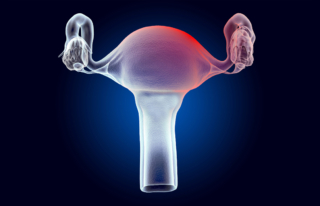 Endométriose : optimiser le conseil à l’officine