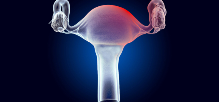 Endométriose : optimiser le conseil à l&rsquo;officine