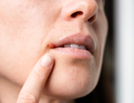 Hormis un antiviral, que conseiller pour accélérer la cicatrisation d’un bouton de fièvre ?