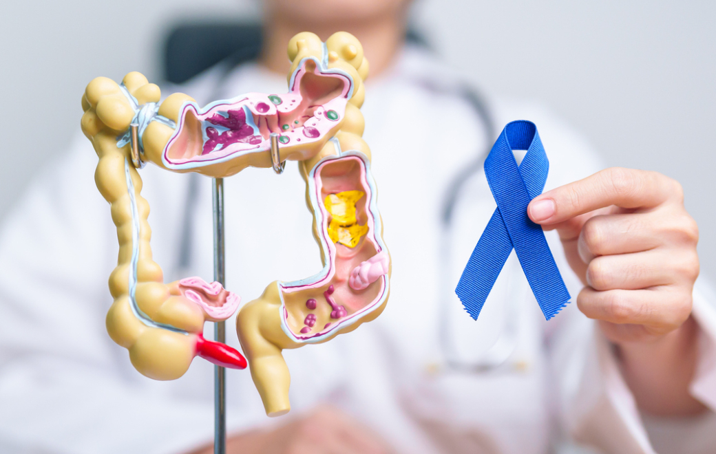 Cancer colorectal : identifier les risques pour mieux prévenir