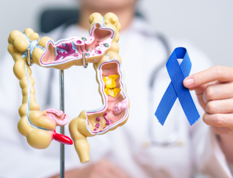 Cancer colorectal : identifier les risques pour mieux prévenir