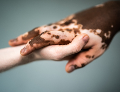 Vitiligo : comprendre la maladie