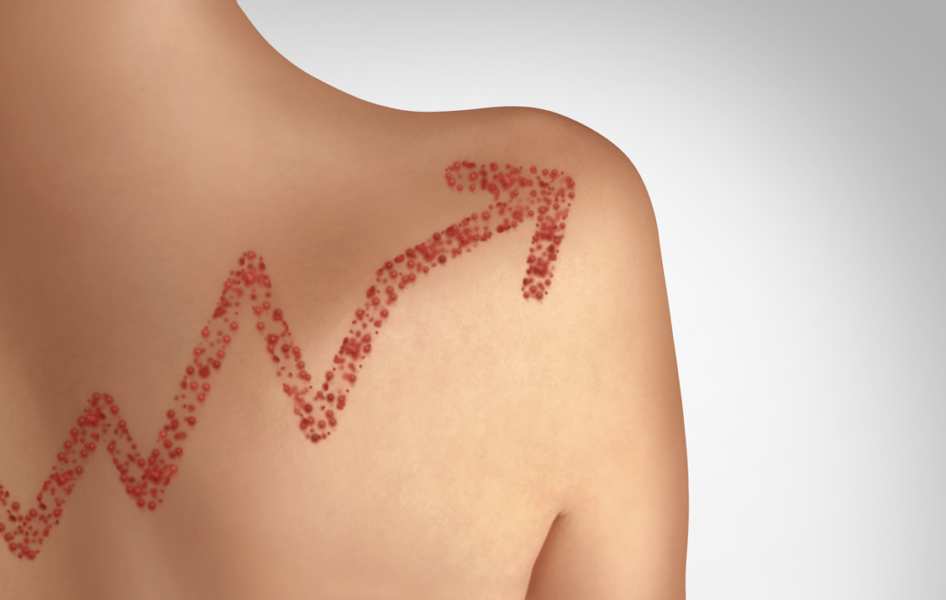 Rougeole : autant de cas sur le premier trimestre 2025 que sur toute l’année 2024 !