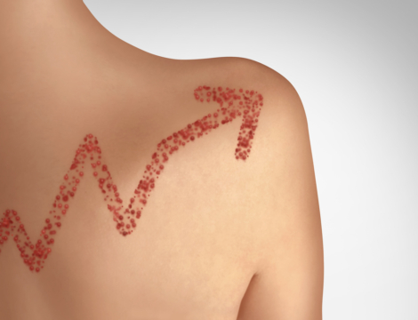 Rougeole : autant de cas sur le premier trimestre 2025 que sur toute l’année 2024 !