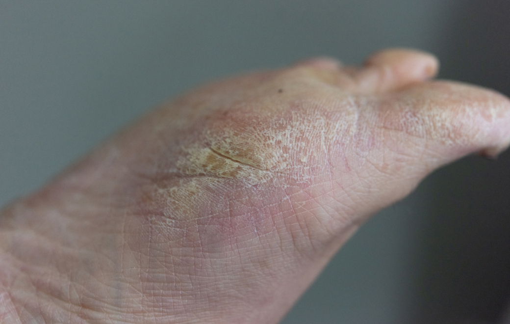 Pourquoi les patients diabétiques présentent un risque accru de complication au niveau des pieds ?