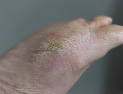 Pourquoi les patients diabétiques présentent un risque accru de complication au niveau des pieds ?