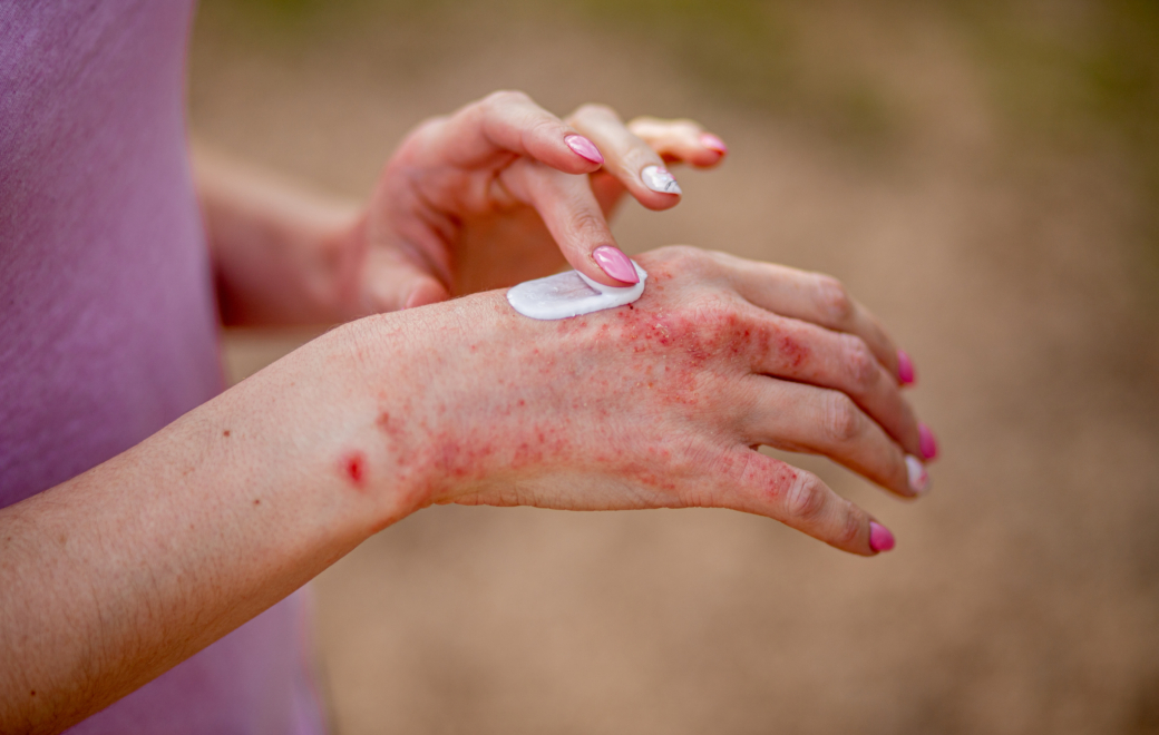 Désonide par voie topique : les éléments clés pour une bonne dispensation