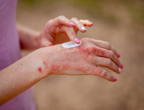 Désonide par voie topique : les éléments clés pour une bonne dispensation
