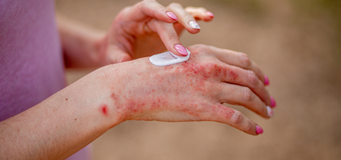 Désonide par voie topique : les éléments clés pour une bonne dispensation