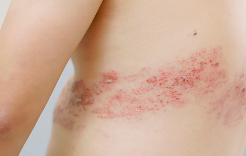 1/5 – Pathologie : le zona en 6 questions