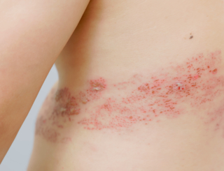 1/5 – Pathologie : le zona en 6 questions