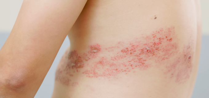 1/5 – Pathologie : le zona en 6 questions