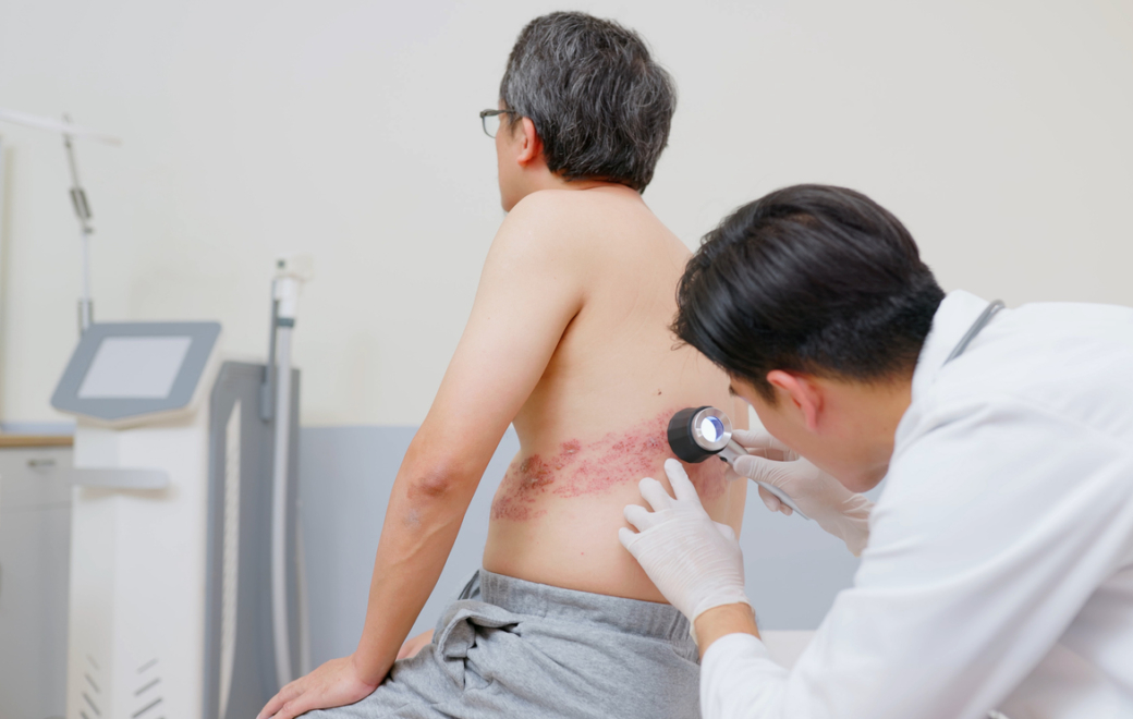 Pourquoi vacciner contre le zona chez le sujet âgé ?