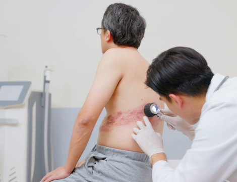 Pourquoi vacciner contre le zona chez le sujet âgé ?