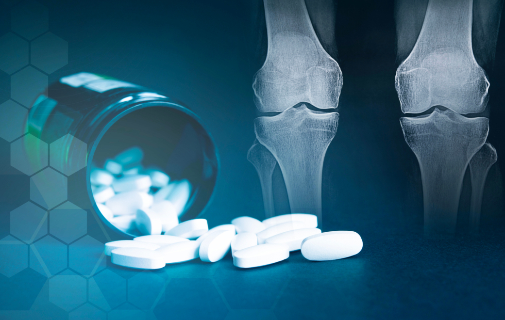 Chondroïtine : comment bien la conseiller dans l’arthrose ?