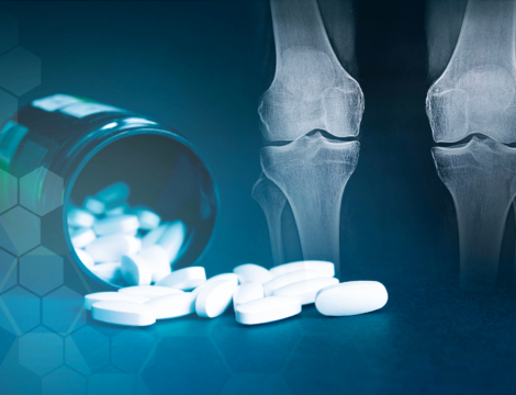 Chondroïtine : comment bien la conseiller dans l’arthrose ?