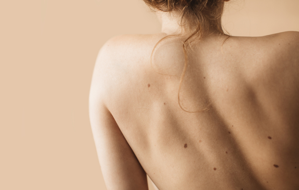 Mélanomes cutanés : des percées pour sauver sa peau