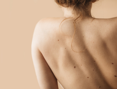 Mélanomes cutanés : des percées pour sauver sa peau