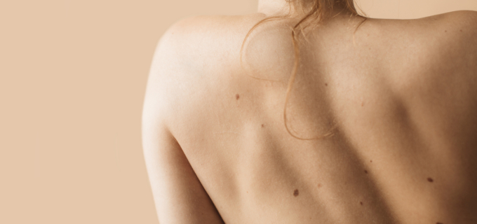 Mélanomes cutanés : des percées pour sauver sa peau