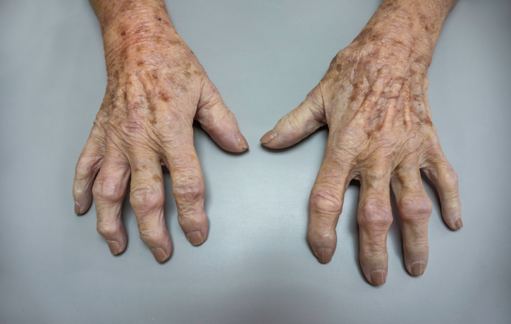 Polyarthrite rhumatoïde : l’accompagnement au comptoir