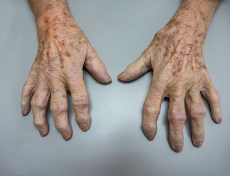 Polyarthrite rhumatoïde : l’accompagnement au comptoir