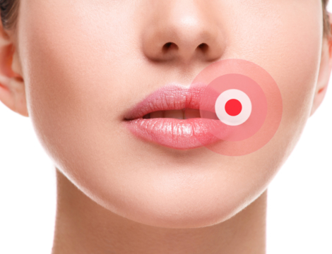 Herpès labial : quelle prise en charge en officine ?