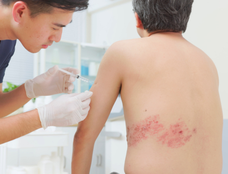 La vaccination contre le zona à l’officine