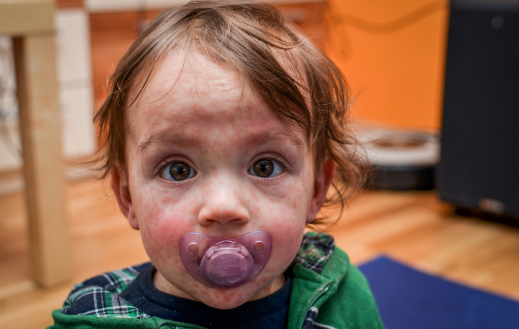 Rougeole en France : une recrudescence préoccupante en 2025