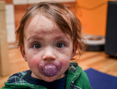 Rougeole en France : une recrudescence préoccupante en 2025