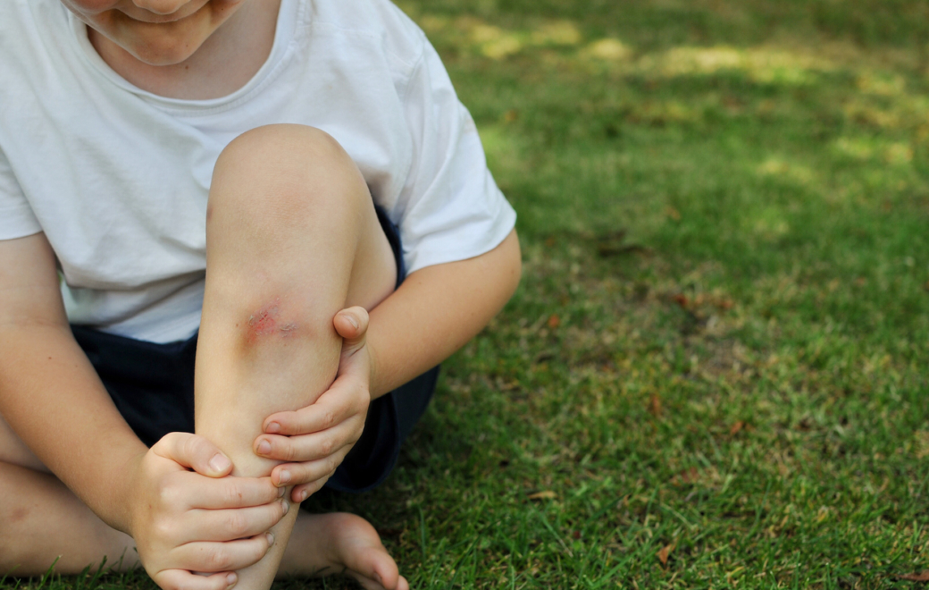 Conseils à l’officine : zoom sur les petits maux de l’été