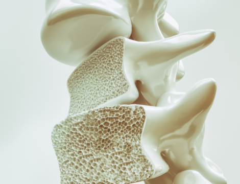 Ostéoporose : comment accompagner les patients au comptoir ?