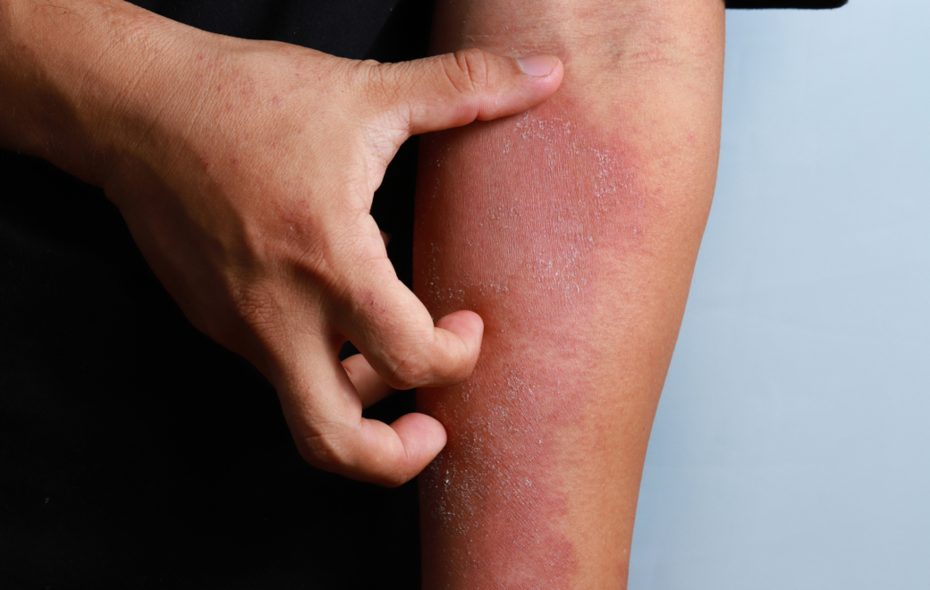 Comment choisir ses vêtements quand on a de l’eczéma ?