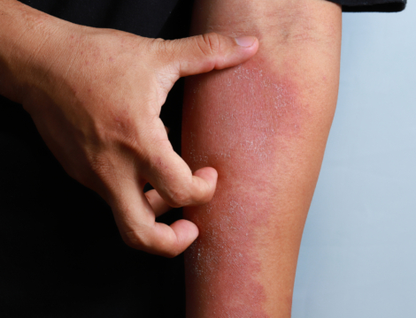 Comment choisir ses vêtements quand on a de l’eczéma ?