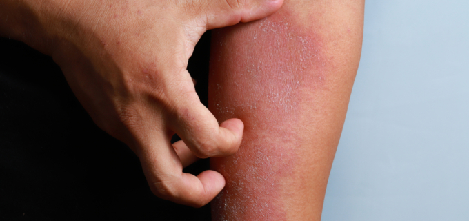 Comment choisir ses vêtements quand on a de l’eczéma ?